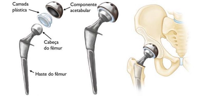 01_Artroplastia-de-Quadril1-768x374
