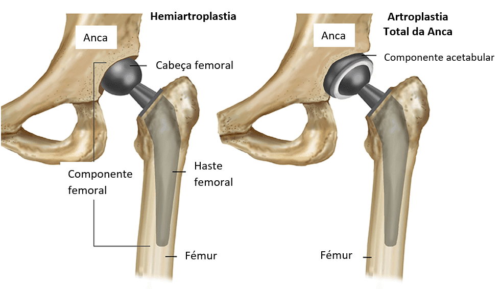 01_Artroplastia-de-Quadril3