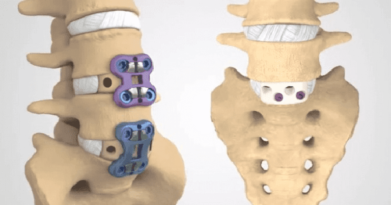 01_Atrodese-da-Coluna-Via-Anterior_ALIF1-min-768x402