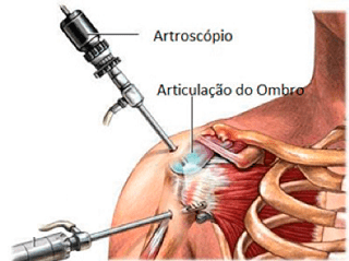 01_Tratamento-Cirúrgico-para-Tendinopatia1-1