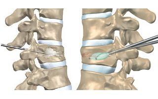 3.0_Cifoplastia__Vertebroplastia-1