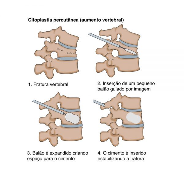 3.1_Cifoplastia4-600x600