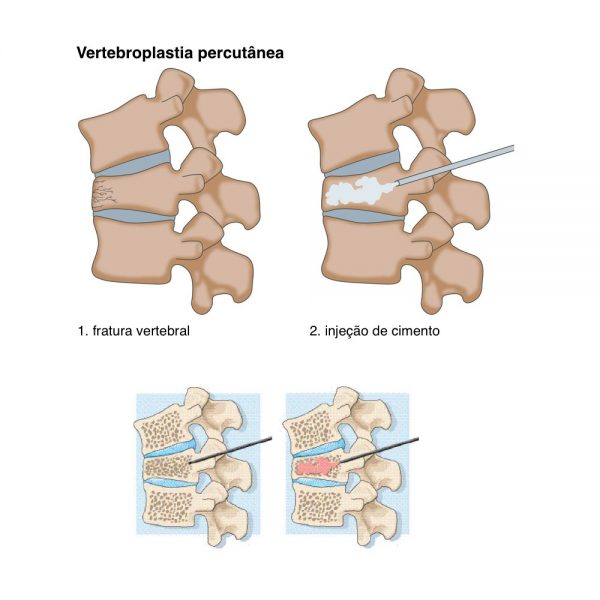 3.2_Vertebroplastia1-600x600