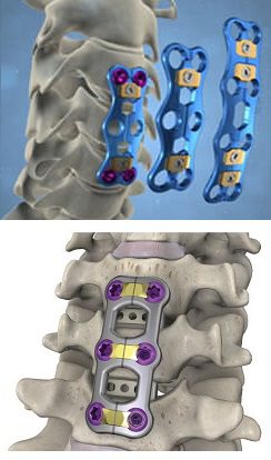 9_Artrodese-Cervical2-1 (1)