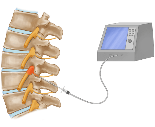 Pulsed_Radiofrequency_Treatment_opt