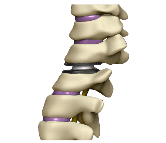 artroplastia-cervical-2021
