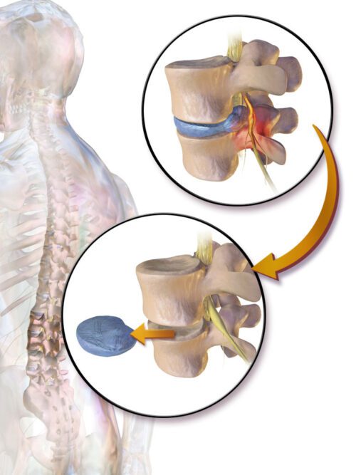 disc-protrusion-large