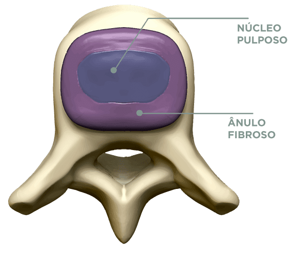 nucleoplastia-2