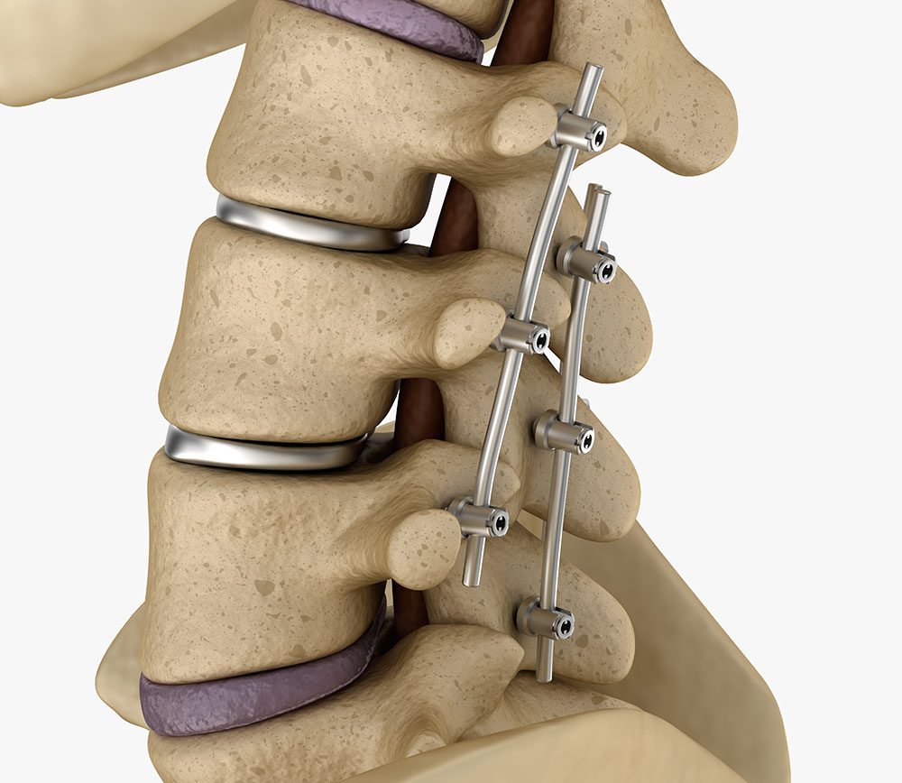 spondylodesia-2