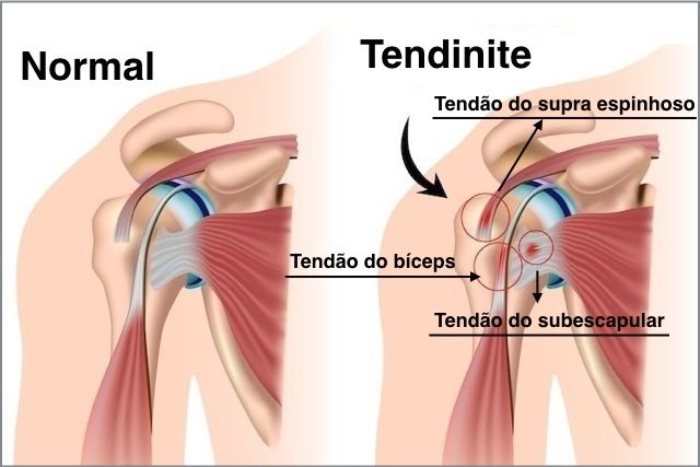 tendinopatia-ombro