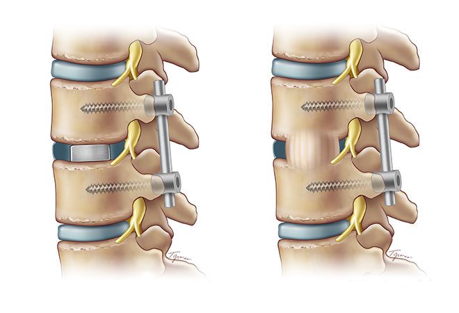 tlif-surgery-fusion-660