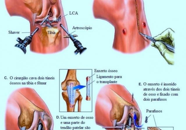 02_Ligamentoplastia1-639x450