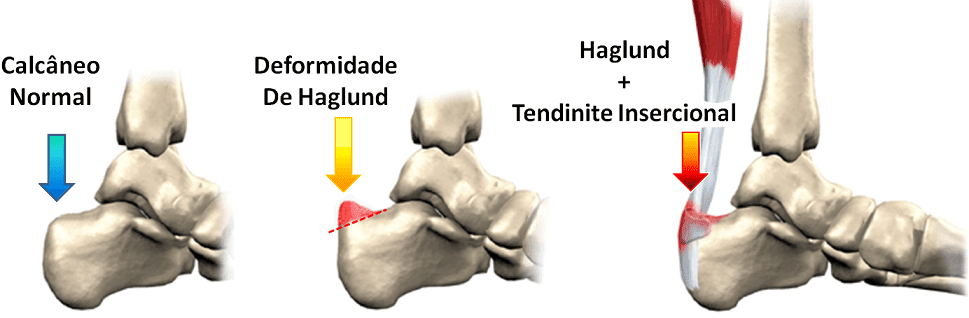 03_Lesão-de-Haglund1