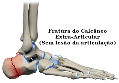 04_Fraturas-no-Pé4-1