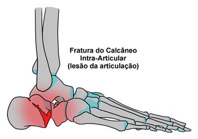 04_Fraturas-no-Pé5